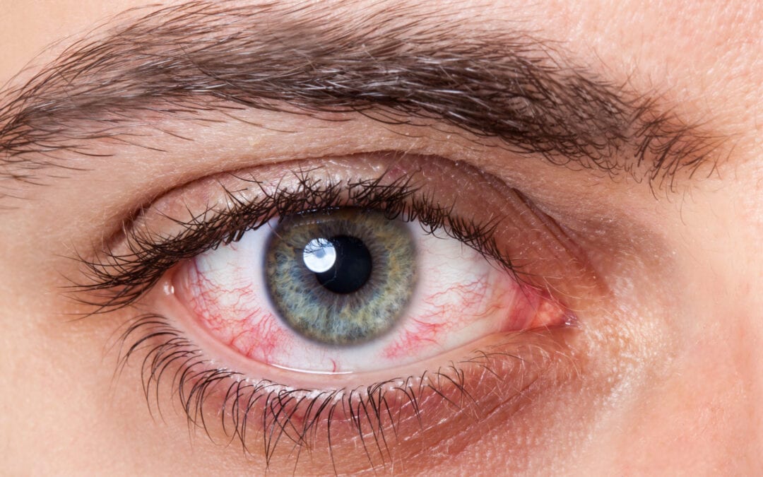 Iritis Treatment and information
